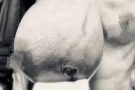 Cắt bỏ khối u vú nặng hơn 3kg cho người phụ nữ 49 tuổi