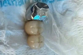 Nuốt cầu răng giả khi ăn phở, dị vật thế nào nguy hiểm?