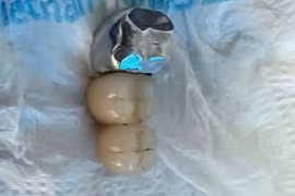 Nuốt cầu răng giả khi ăn phở, dị vật thế nào nguy hiểm?