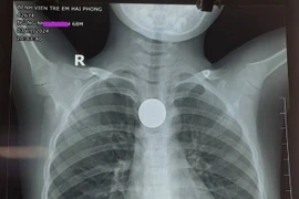 Gắp thành công đồng xu ra khỏi thực quản bé 6 tuổi 