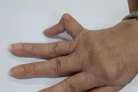 Các triệu chứng thường thấy của bệnh viêm khớp dạng thấp