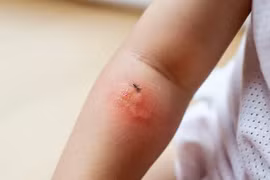 Những lưu ý khi dùng thuốc chống muỗi