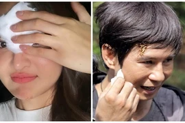 Thùy Anh khâu 4 mũi trên trán, loạt sao gặp tai nạn phim trường