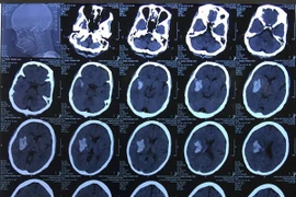 Cắt phăng mảnh sọ cứu sống bệnh nhân chảy máu não ồ ạt