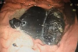 Cô gái có hai tượng Phật bằng kim loại nằm gọn trong dạ dày