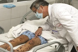 Đừng nhầm sốt xuất huyết với bệnh có thể chết trong vòng 24 giờ