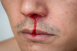 Những dấu hiệu cho thấy bạn bị thiếu vitamin C