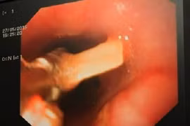 Hóc xương - không thể chủ quan 