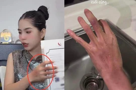 Hằng Du Mục lên livestream với gương mặt bầm tím, netizen lo lắng