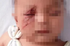 Bọ bay tới mặt con, mẹ đưa tay vỗ khiến mặt con biến dạng 