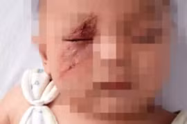 Bọ bay tới mặt con, mẹ đưa tay vỗ khiến mặt con biến dạng 