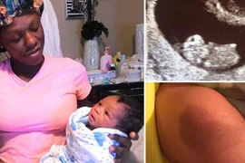 Vết bớt trên người bé trai và sự trùng hợp kỳ diệu với em gái song sinh đã mất