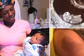 Vết bớt trên người bé trai và sự trùng hợp kỳ diệu với em gái song sinh đã mất