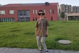 Chàng trai có xương sống cong như sợi mì chỉ vì thiếu vitamin này