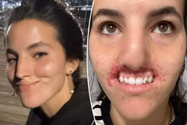 Người mẫu mất toàn bộ môi trên vì bị chó dữ tấn công