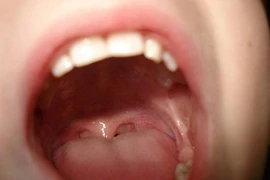 Thấy đốm trên lưỡi tưởng bệnh tình dục, ai ngờ ung thư