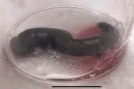 Ớn lạnh bé gái bị đỉa chui vào lỗ mũi ký sinh