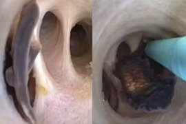 Ăn cá kiểu này, người đàn ông khiến bác sĩ run rẩy