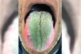 Lưỡi mọc lông xanh kỳ lạ vì uống thuốc kháng sinh quá liều