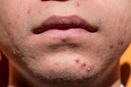 Mụn nổi nhiều ở vị trí này trên mặt dấu hiệu 5 loại bệnh này