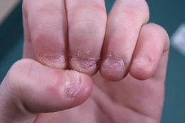 Thường xuyên cắn móng tay, bé trai suýt phải cắt cụt chi