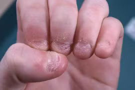 Thường xuyên cắn móng tay, bé trai suýt phải cắt cụt chi