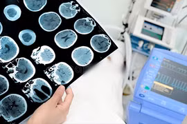 Những biểu hiệu của người bị nhồi máu não