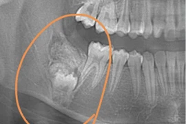Đi chỉnh nha, bé gái được yêu cầu phẫu thuật ngay vì bệnh hiểm