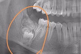 Đi chỉnh nha, bé gái được yêu cầu phẫu thuật ngay vì bệnh hiểm