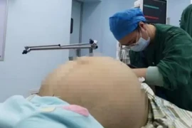 Tưởng mang thai đôi, nào ngờ cô gái có khối u nặng 21 kg