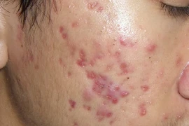 Dùng kem chống nắng kiểu này, thế nào ung thư cũng "ghé thăm"