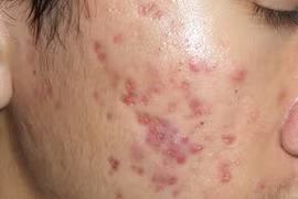 Dùng kem chống nắng kiểu này, thế nào ung thư cũng "ghé thăm"