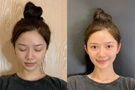 Hết hồn mốt phẫu thuật thẩm mỹ tai yêu tinh và tạo chân thon