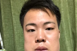 Nhổ cùng lúc 4 chiếc răng khôn, thanh niên mặt sưng như quả đu đủ 