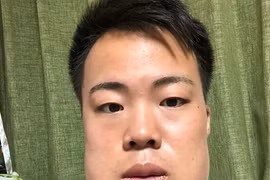 Nhổ cùng lúc 4 chiếc răng khôn, thanh niên mặt sưng như quả đu đủ 