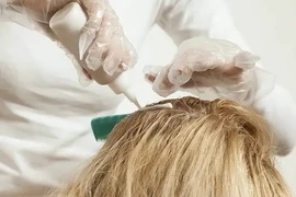 Cô gái bị viêm gan do mỗi tháng nhuộm tóc 2 lần