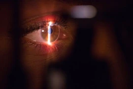 Con nhỏ keo 502 vào mắt, cách bố xử lý được bác sĩ khen