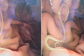 Cứ ăn món này là tiêu chảy, thanh niên trả giá vì sở thích 