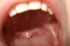 Ung thư lưỡi mà tưởng bị sỏi amidan