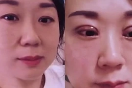 Chồng suốt ngày đòi ly hôn vì cô vợ đi cắt mí mắt 