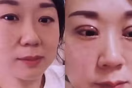 Chồng suốt ngày đòi ly hôn vì cô vợ đi cắt mí mắt 