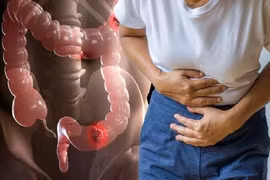 Coi chừng ung thư ghé thăm khi xuất hiến 4 dấu hiệu bất thường 