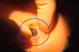 Gần gũi chó cưng, bé trai bị ký sinh trùng làm tổ trong mắt 