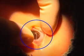 Gần gũi chó cưng, bé trai bị ký sinh trùng làm tổ trong mắt 