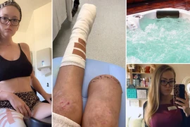  Nhậu say ngủ quên, gái trẻ sốc nặng khi tỉnh dậy thấy chân bị cưa cụt