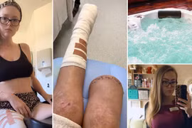  Nhậu say ngủ quên, gái trẻ sốc nặng khi tỉnh dậy thấy chân bị cưa cụt