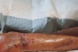 Nhiễm vi khuẩn ăn thịt người khi ăn tôm, người đàn ông phải cắt cụt cánh tay 