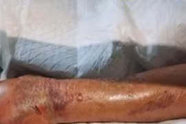 Nhiễm vi khuẩn ăn thịt người khi ăn tôm, người đàn ông phải cắt cụt cánh tay 