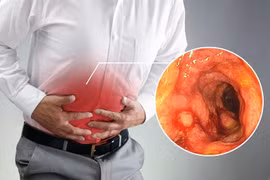 3 sự cố có thể là dấu hiệu của ung thư trực tràng 