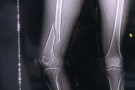 Tập yoga quá độ, thanh niên suýt liệt luôn chân